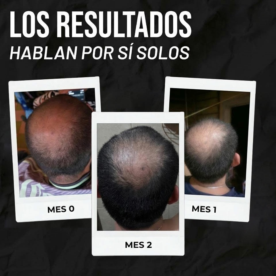 Tónico Minoxidil